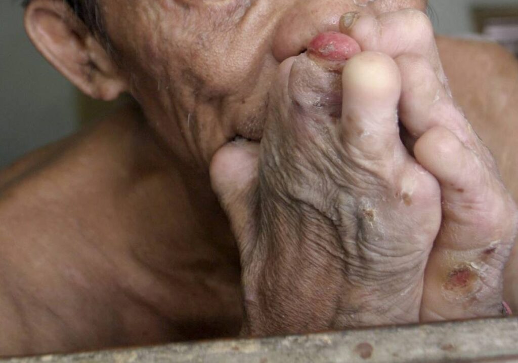 Alerta en México por aumento en casos de lepra