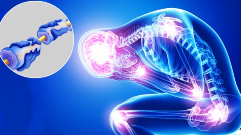 Relacionan síntomas de Guillain-Barré con vacunas Covid-19